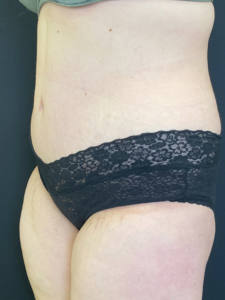 Abdominoplasty (Tummy Tuck) Before and After Pictures Buffalo, NY