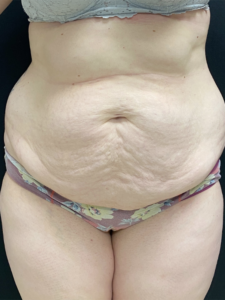 Abdominoplasty (Tummy Tuck) Before and After Pictures Buffalo, NY
