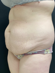 Abdominoplasty (Tummy Tuck) Before and After Pictures Buffalo, NY