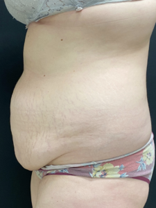 Abdominoplasty (Tummy Tuck) Before and After Pictures Buffalo, NY
