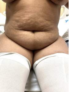 Abdominoplasty (Tummy Tuck) Before and After Pictures Buffalo, NY