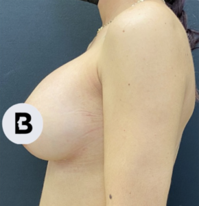 Breast Augmentation Before and After Pictures Buffalo, NY