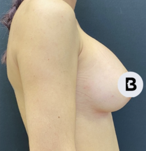 Breast Augmentation Before and After Pictures Buffalo, NY