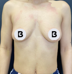 Breast Augmentation Before and After Pictures Buffalo, NY