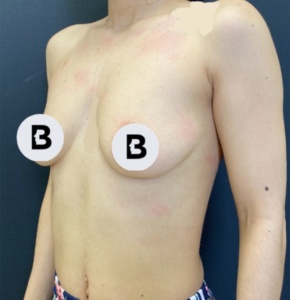 Breast Augmentation Before and After Pictures Buffalo, NY