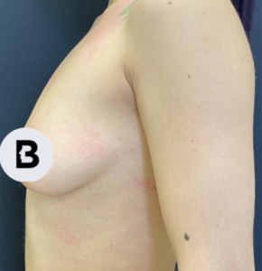 Breast Augmentation Before and After Pictures Buffalo, NY