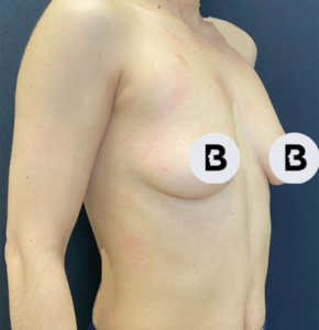 Breast Augmentation Before and After Pictures Buffalo, NY