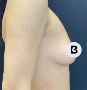 Breast Augmentation Before and After Pictures Buffalo, NY