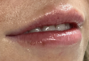 Lip Fillers Before and After Pictures Buffalo, NY