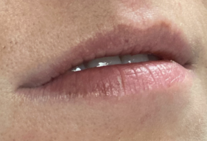 Lip Fillers Before and After Pictures Buffalo, NY