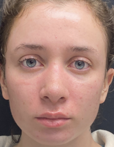 Rhinoplasty (Nose Surgery) Before and After Pictures Buffalo, NY
