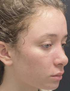 Rhinoplasty (Nose Surgery) Before and After Pictures Buffalo, NY