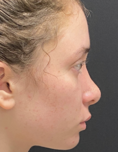 Rhinoplasty (Nose Surgery) Before and After Pictures Buffalo, NY