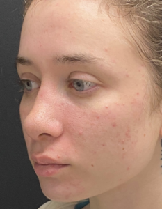 Rhinoplasty (Nose Surgery) Before and After Pictures Buffalo, NY