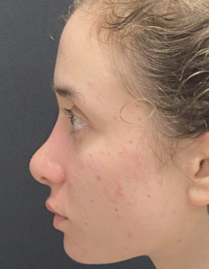 Rhinoplasty (Nose Surgery) Before and After Pictures Buffalo, NY