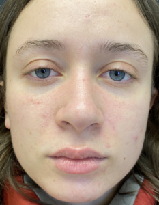 Rhinoplasty (Nose Surgery) Before and After Pictures Buffalo, NY