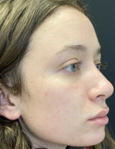 Rhinoplasty (Nose Surgery) Before and After Pictures Buffalo, NY