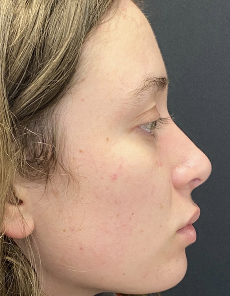 Rhinoplasty (Nose Surgery) Before and After Pictures Buffalo, NY