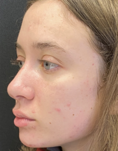 Rhinoplasty (Nose Surgery) Before and After Pictures Buffalo, NY