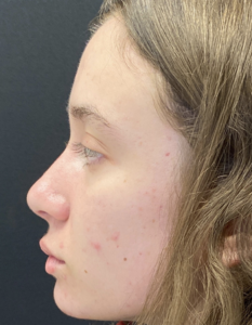 Rhinoplasty (Nose Surgery) Before and After Pictures Buffalo, NY