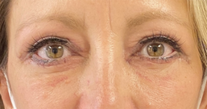 Blepharoplasty (Eyelid Surgery) Before and After Pictures in Buffalo, NY