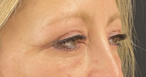 Blepharoplasty (Eyelid Surgery) Before and After Pictures in Buffalo, NY