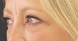 Blepharoplasty (Eyelid Surgery) Before and After Pictures in Buffalo, NY