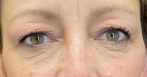 Blepharoplasty (Eyelid Surgery) Before and After Pictures in Buffalo, NY