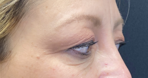 Blepharoplasty (Eyelid Surgery) Before and After Pictures in Buffalo, NY