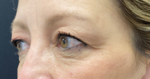Blepharoplasty (Eyelid Surgery) Before and After Pictures in Buffalo, NY