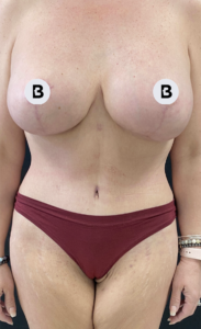 Breast Augmentation Before and After Pictures Buffalo, NY