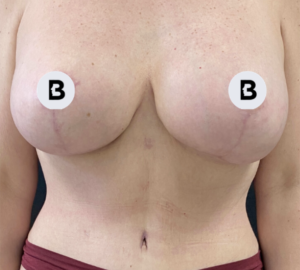Breast Reduction Before and After Pictures in Buffalo, NY