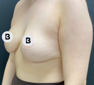 Breast Reduction Before and After Pictures in Buffalo, NY