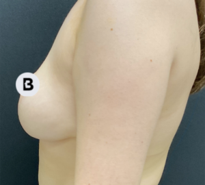 Breast Reduction Before and After Pictures in Buffalo, NY