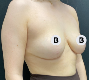 Breast Reduction Before and After Pictures in Buffalo, NY