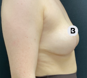 Breast Reduction Before and After Pictures in Buffalo, NY