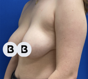 Breast Reduction Before and After Pictures in Buffalo, NY