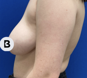 Breast Reduction Before and After Pictures in Buffalo, NY
