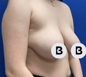 Breast Reduction Before and After Pictures in Buffalo, NY