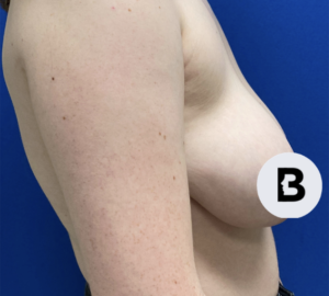 Breast Reduction Before and After Pictures in Buffalo, NY