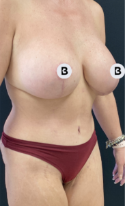 Breast Augmentation Before and After Pictures Buffalo, NY