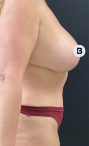 Breast Augmentation Before and After Pictures Buffalo, NY