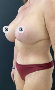 Breast Augmentation Before and After Pictures Buffalo, NY