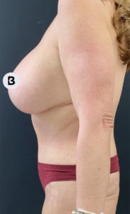 Mastopexy (Breast Lift) Before and After Pictures in Buffalo, NY