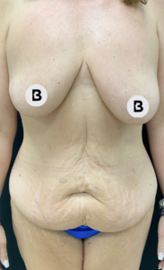 Mastopexy (Breast Lift) Before and After Pictures in Buffalo, NY
