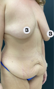 Breast Augmentation Before and After Pictures Buffalo, NY