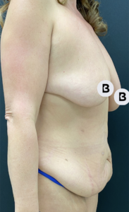 Breast Augmentation Before and After Pictures Buffalo, NY