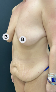 Mastopexy (Breast Lift) Before and After Pictures in Buffalo, NY