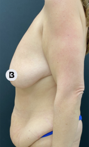 Breast Augmentation Before and After Pictures Buffalo, NY