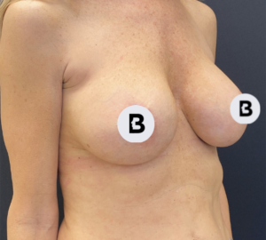Breast Augmentation Before and After Pictures Buffalo, NY